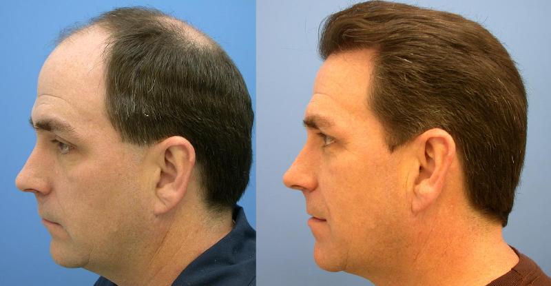 regrow hair from male pattern baldness